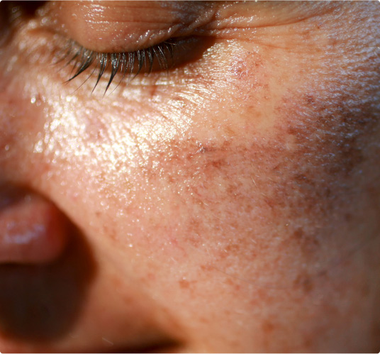 Une solution contre vos complexes de la peau